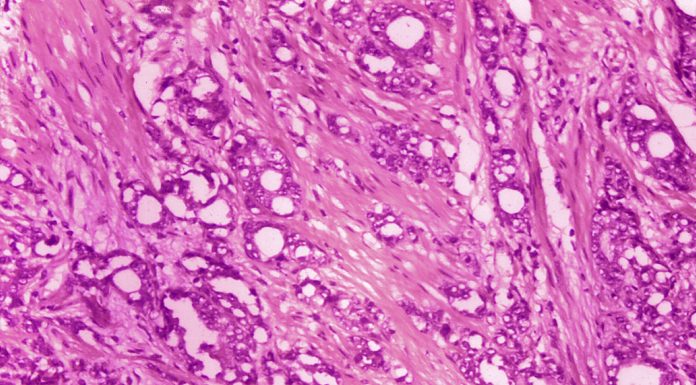 Most prostate cancer can just be watched for years instead of operated on, new long-term study finds most-prostate-cancer-can-just-be-watched-for-years-instead-of-operated-on,-new-long-term-study-finds